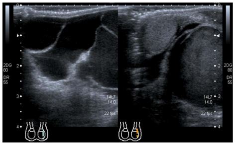 The Scrotal Ultrasound Scan Demonstrates The Multilocular Cystic