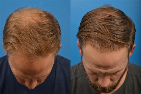 Hair Restoration Photos Melbourne Fl Patient 6388