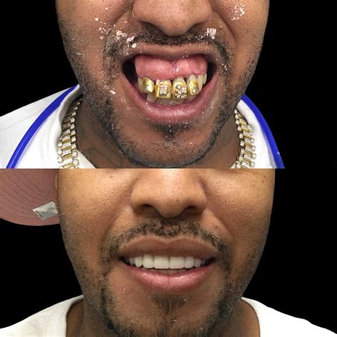 Immediate Dentures — Memphis Dentures And Implants