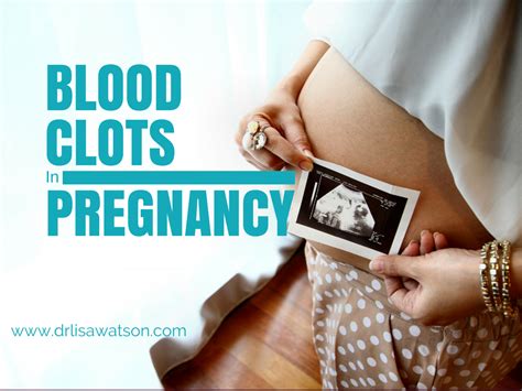 Blood Clots In Pregnancy Dr Lisa Watson