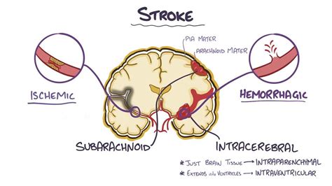 Intracerebral Hemorrhage Video Anatomy Definition Osmosis