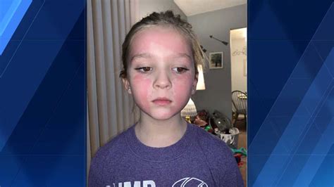She Said It Burns Really Bad Omaha Mom Warns Others After Daughters Reaction To Face Mask