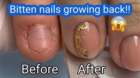 Bitten Nails Growing Back Amazing Transformation With Gel Overlay