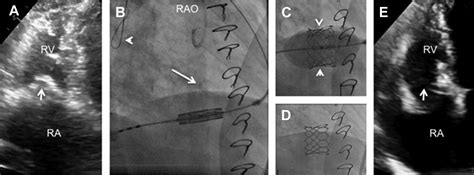 Transcatheter Tricuspid Valve Replacement Interventional Cardiology