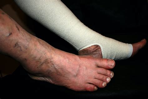 Bandage The Leg Ulcers Sergio Mazzei