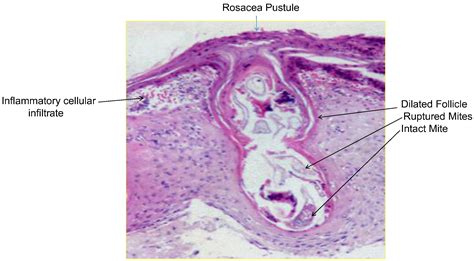 References In Demodex And Rosacea Revisited Clinics In Dermatology