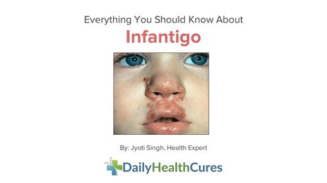 Infantigo Types Causes Contagious Symptoms And Treatments Youtube