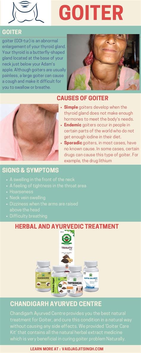 Goiter Causes Symptoms And Herbal Treatment