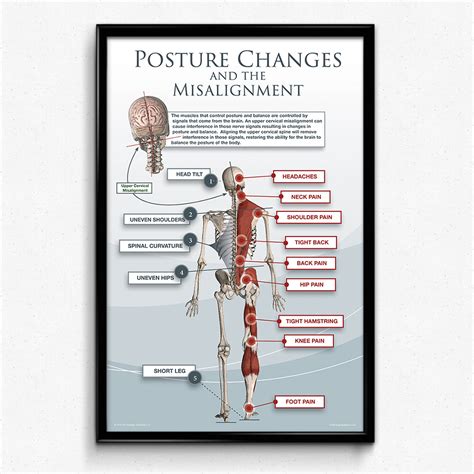 Posture Changes From An Upper Cervical Misalignment Poster