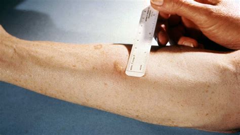 What Does A Positive Tb Skin Test Look Like