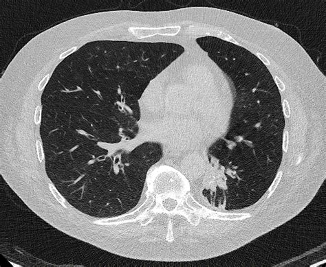 Ultra Low Dose CT Chest Radiology SA