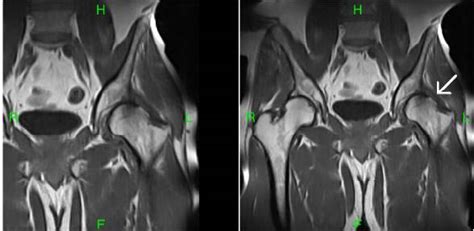 Femoro Acetabular Impingement Mri Sumers Radiology Blog