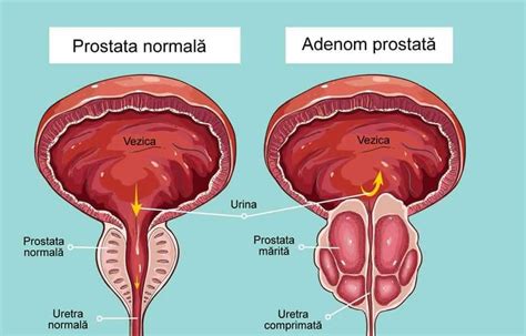 Adenom De Prostata Cauze Simptome Tratament Medicamentos Remedii My