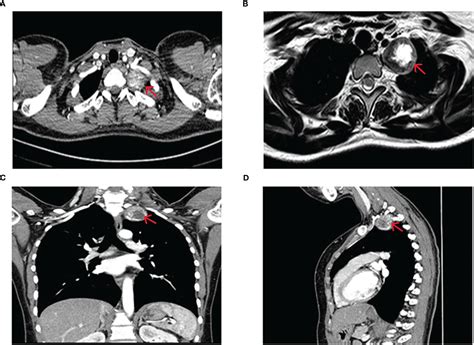 Frontiers Case Report Combined Cervical Incision With An Intercostal