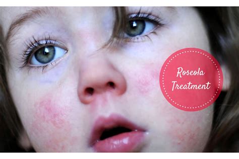 Roseola Rash Try These Home Remedies To Treat Roseola Virus