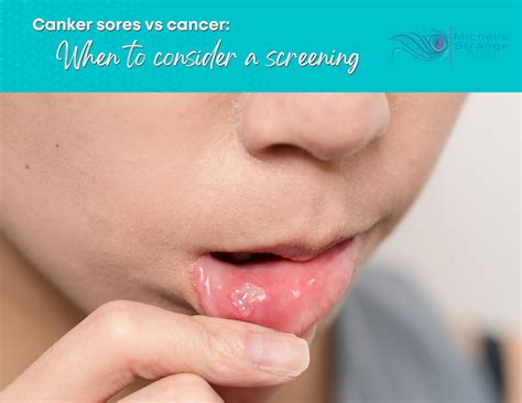 Canker Sores Vs Cancer When To Consider A Screening