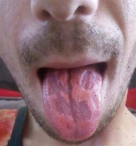 Horrific Photo Shows Teachers Tongue ‘eaten Away After Downing Six