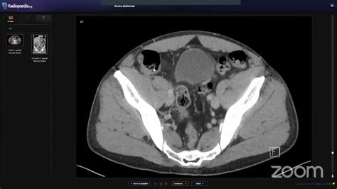 Ct Abdomen And Pelvis Interpretation Mind The Bleep