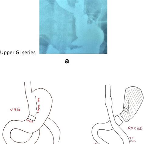 Roux En Y Gastric Bypass A Upper Gi Series B Before And After The