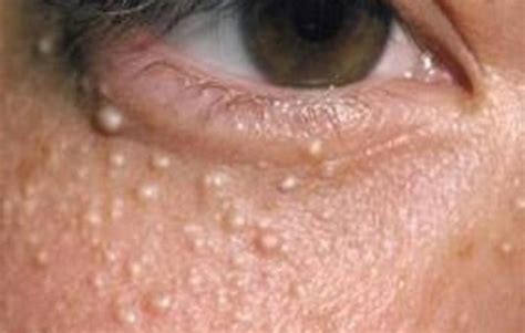 Jerawat tanpa mata, disebut juga jerawat batu, acne cyst, atau nodule, adalah jerawat yang tumbuh sangat dalam di kulit sehingga tidak bisa mengeluarkan nanah. Jerawat di Bawah Mata? Bisa Jadi Milia, Ini Cara ...
