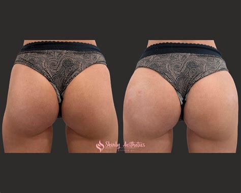 Sculptra Butt Before After Results All You Need To Know