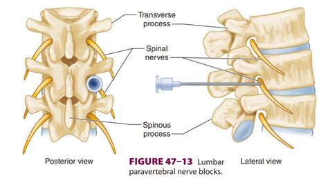Spinal Nerve Block