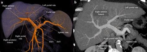 Anatomy Abdomen And Pelvis Portal Venous System Hepatic Portal