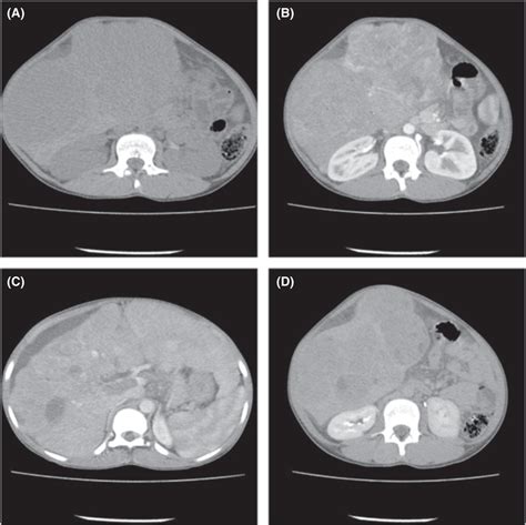 Ad Shows Triple‐phase Ct Scan Of The Liver A Noncontrast Image Of