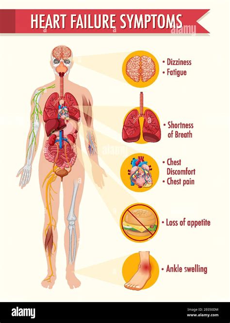Heart Failure Symptoms Information Infographic Illustration Stock