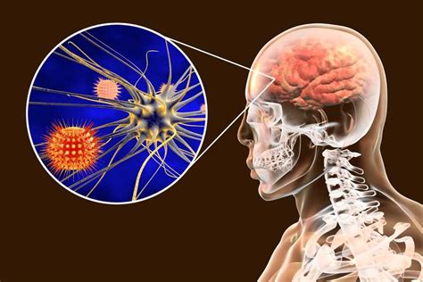 Meningitis Symptoms 11 Most Important Signs And Symptoms