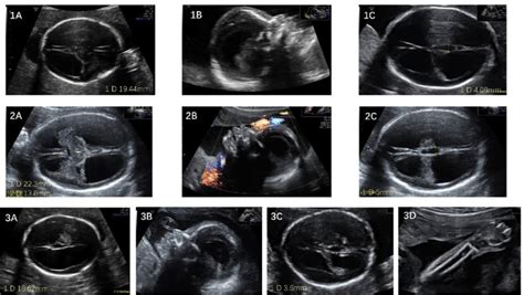 Fetal Hydrocephalus Ultrasound