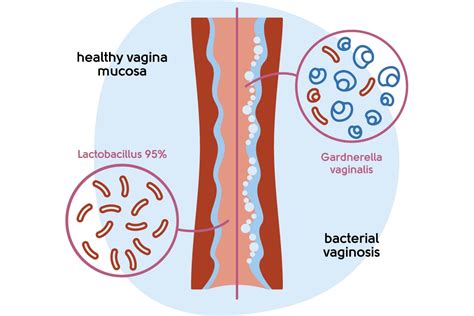 Menopause Symptoms Vaginal Dryness My Menopause Centre