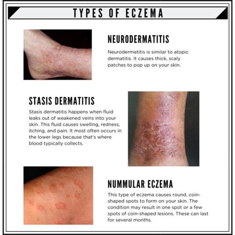 7 Types Of Eczema And Its Symptoms In 2021 Itching Dry Skin Eczema