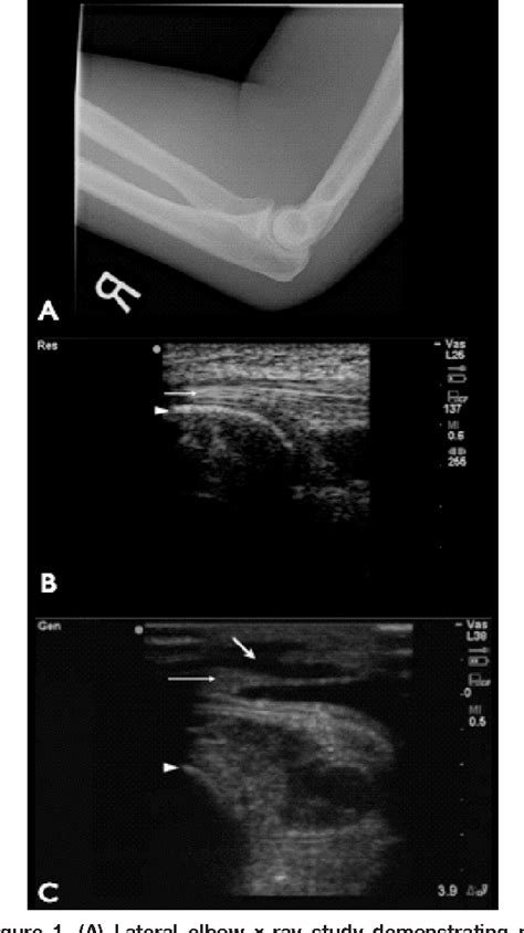Figure 1 From Ultrasound Diagnosis Of Traumatic Partial Triceps Tendon