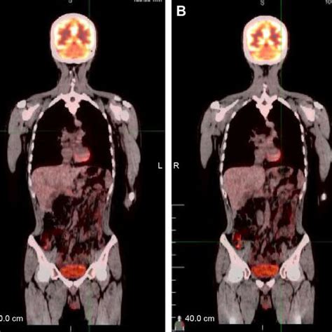 Abdominal Ct Findings A Ct Scan Showing Diffuse Hypodense Enlargement