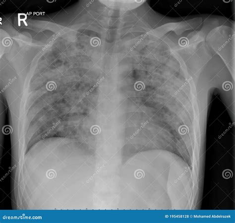 X Ray Of The Chest In A Patient With Active Pulmonary Tuberculosis Tb