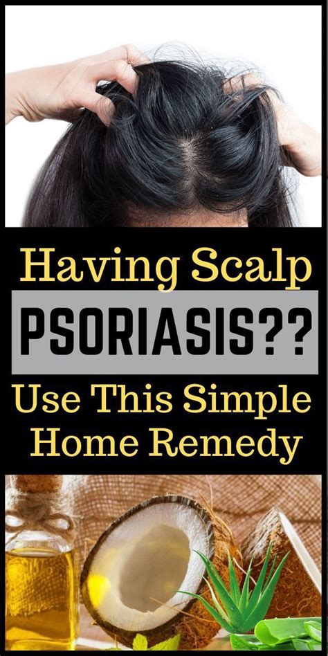 Home Remedies To Treat Scalp Psoriasis Scalp Psoriasis Remedies
