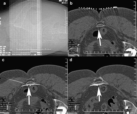 Ct Guided Injection For Ganglion Impar Blockade A Radiological