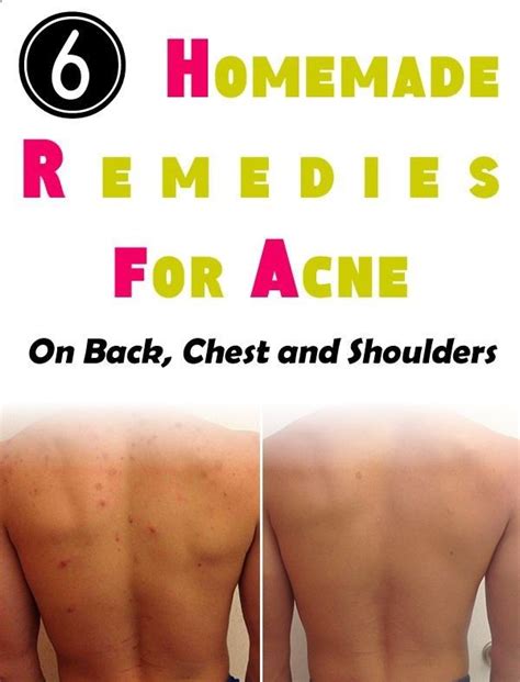 6 Homemade Remedies For Acne On Back Chest And Shoulders Chest Acne