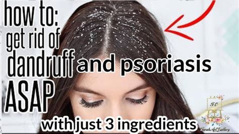 How To Get Rid Of Dandruff And Psoriasishome Remedy To Get Rid Of