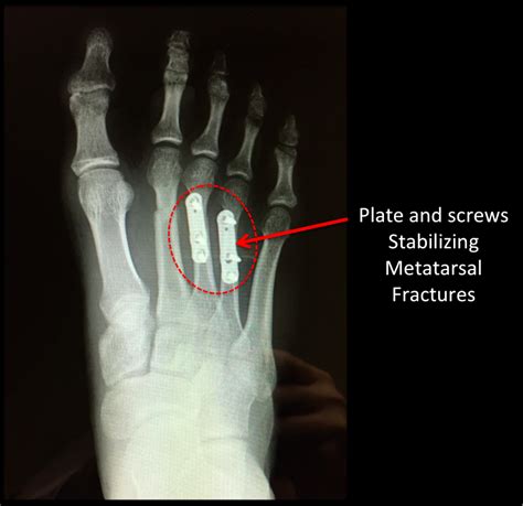 Metatarsal Shaft Fractures Footeducation