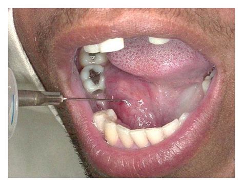 Unusual Dermoid Cyst In Oral Cavity