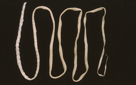 Brain Invading Tapeworm That Eluded Doctors Spotted By New Dna Test