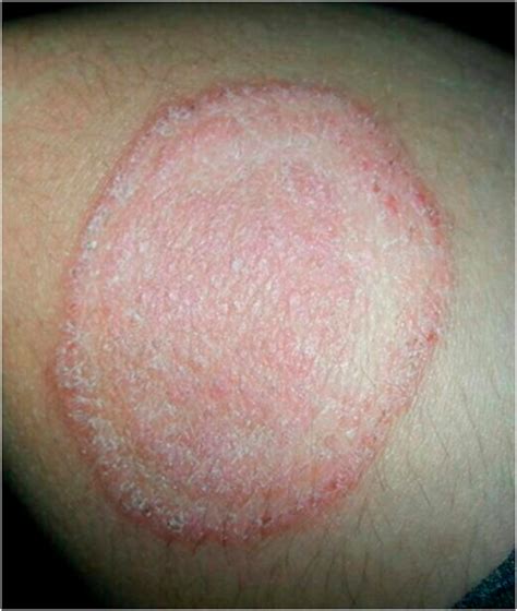 Fungal Skin Infections Articles Pediatrics In Review