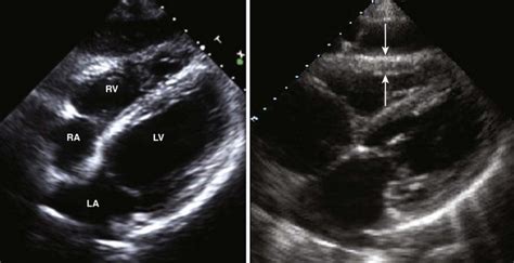 Echocardiography In The Patient With Right Heart Failure Clinical Gate