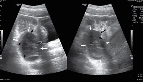 Unusually Painful Ovarian Torsion Radiology Key