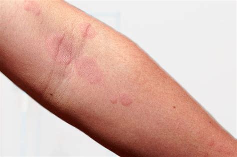 √1000以上 Eczema Rash On Wrist 329558 Contact Dermatitis Rash On Wrist