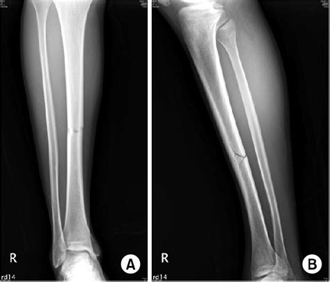 Initial Radiograph Of Right Leg Ap A And Lateral B Shows Right
