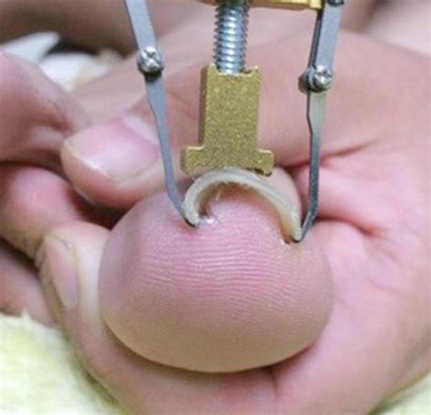 Toenails Growing At An Angle Possible Causes And Treatments