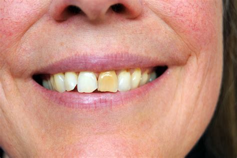 3 Main Reasons Why Teeth Turn Yellow Despite Regularly Brushing Teeth